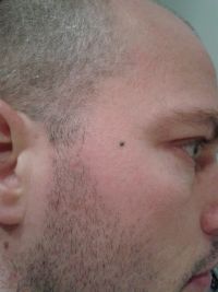 melanoom op rechterslaap.jpg